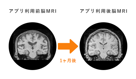 アプリ利用前後 脳MRI